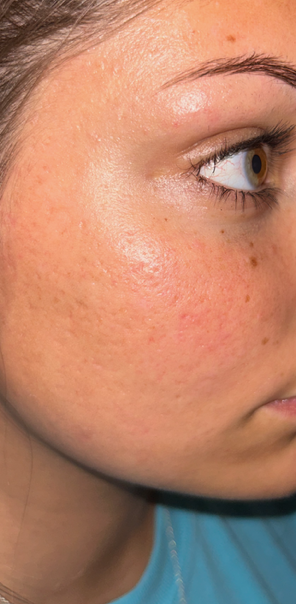 After Image: Microchanneling - right-front-oblique