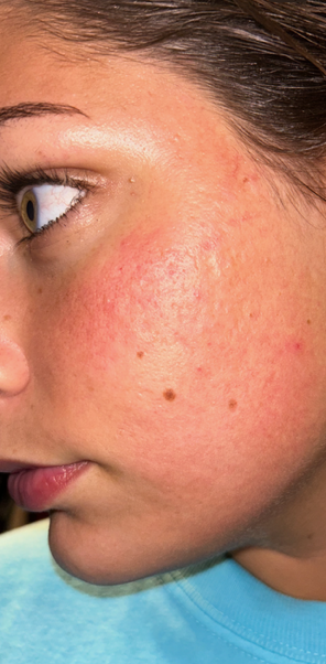After Image: Microchanneling - left-front-oblique