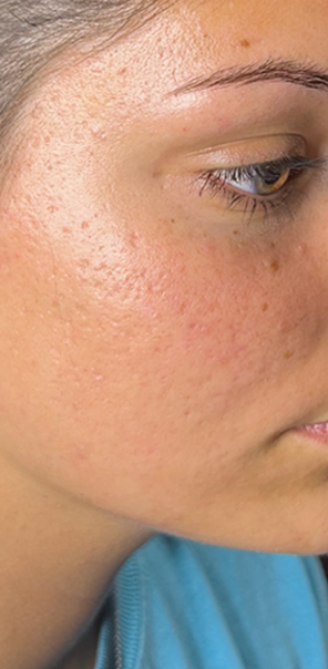 Before Image: Microchanneling - right-front-oblique