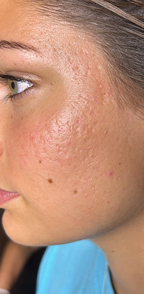 Before Image: Microchanneling - left-front-oblique